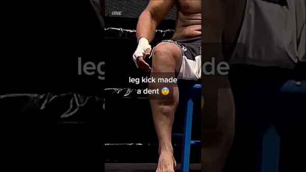 Flashback ⏪ Have you ever seen a dent left in someone’s shin? ⁠
