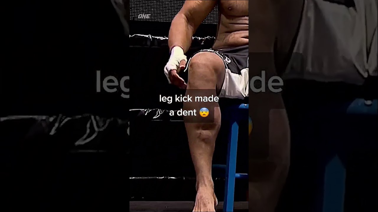 Flashback ⏪ Have you ever seen a dent left in someone’s shin? ⁠